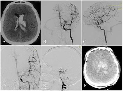 Perioperative Complications of Transvenous Embolization of Ruptured Intracranial Arteriovenous Malformations